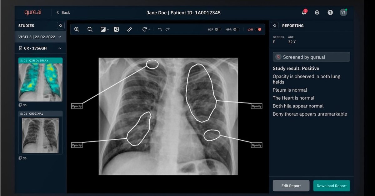 How the NHS Uses AI and Robotics to Speed Cancer Diagnosis