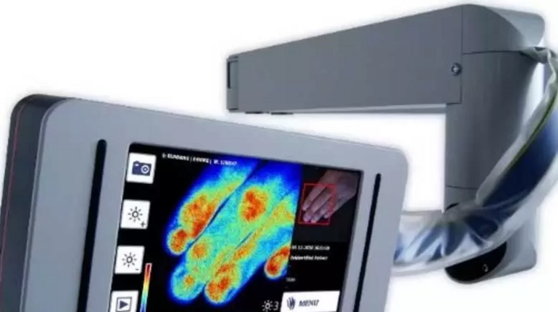 Camera shows blood flow in skin to help burns victims | Healthcare Digital