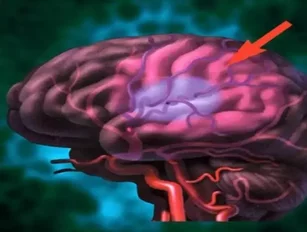 Research shows brain damage from brain stroke can be decreased