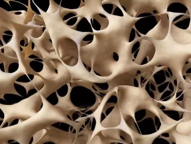 Can We Slow Down and Reverse Osteoporosis? | Healthcare Digital